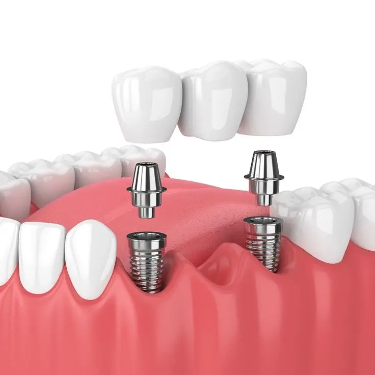 Experienced Cosmetic Dentist & Implant Specialists Serving Cumming, GA